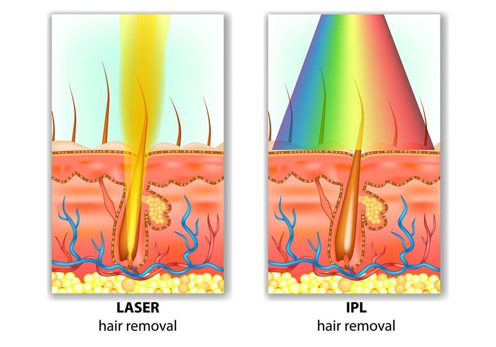 What’s the difference between laser and ipl?